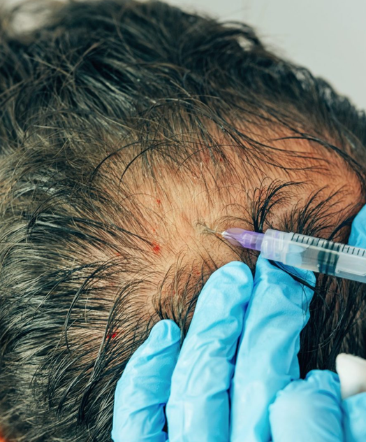 flairhair-hair prp treatment