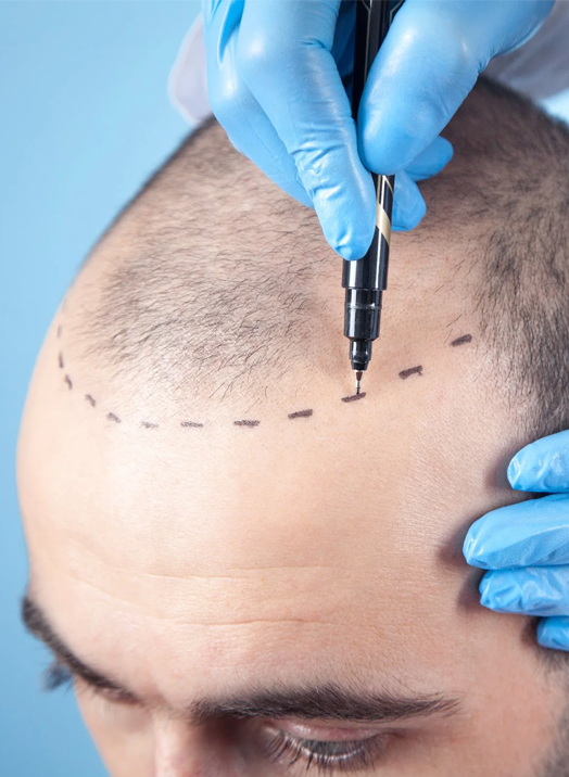 flairhair-hair transplant